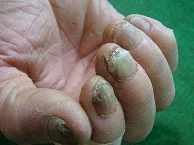 厦门皮肤病医院：灰指甲有什么危害【惠州广肤皮肤病专科医院】