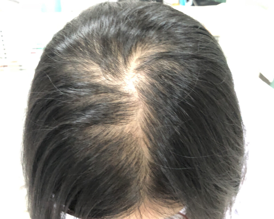 脱发该怎么去预防比较好【厦门广肤皮肤病专科医院怎么样】
